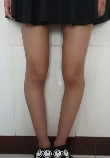 一岁半宝宝o型腿矫正视频,成年人o型腿矫正视频