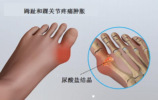 痛风病人应该避免吃哪些食物？