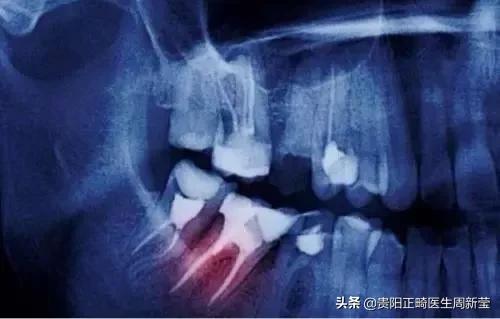 牙疼去看牙需求多久,牙疼的建议