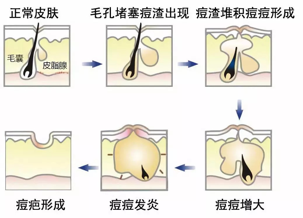 痘痘严重爆发，口服抗生素治疗安全有效吗？