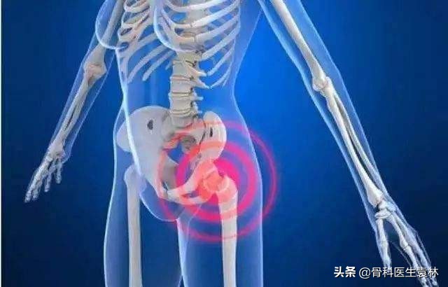股骨头坏死的治疗方法,早期股骨头坏死如何治疗可以治愈
