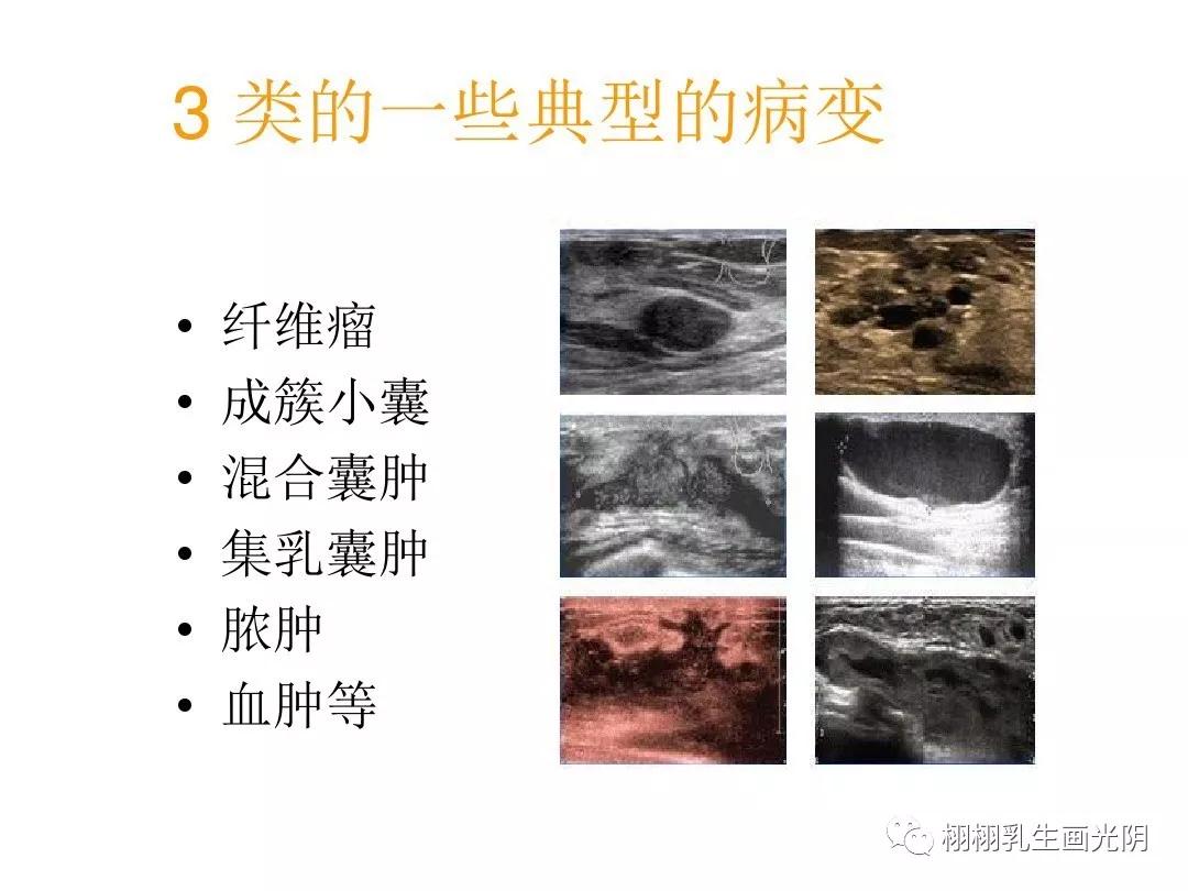 秒懂乳腺超声报告,秒懂超声系列
