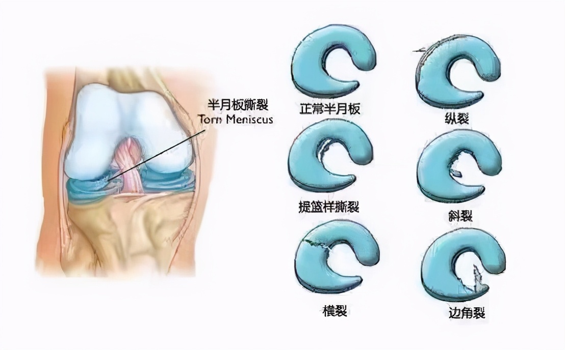 一个动作改善腿型拒绝腿粗瘦腿,一个动作矫正腿型还瘦腿