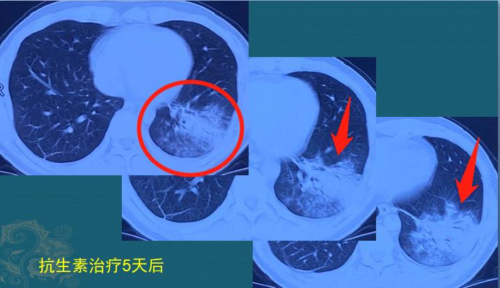 年轻人肺炎出院，花了3万：如果时光倒流，我不去那个养鸡场