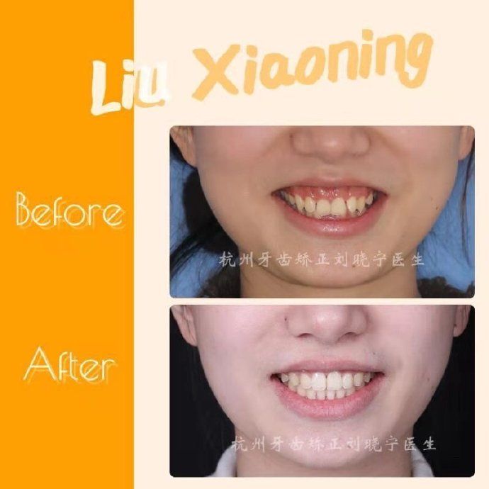 杭州牙齿矫正丨露龈笑怎么办？全面告别露龈笑的4大方法