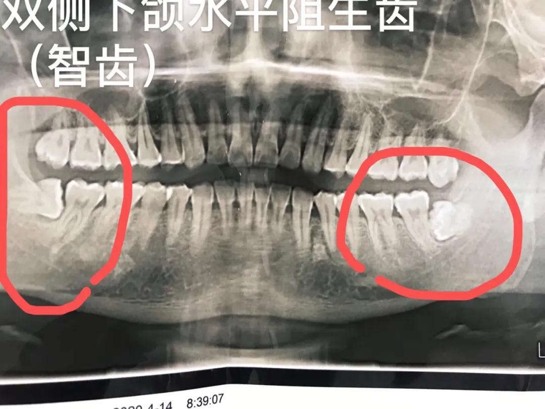 孕妇有牙病可以治吗,备孕牙齿上药需求注意啥