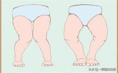 新生儿O型腿怎么办,40至50岁的o型腿能矫正过来吗