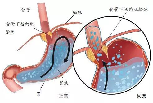 「名医」你按照胃病来治疗却效果不佳？其实是胃食管反流！