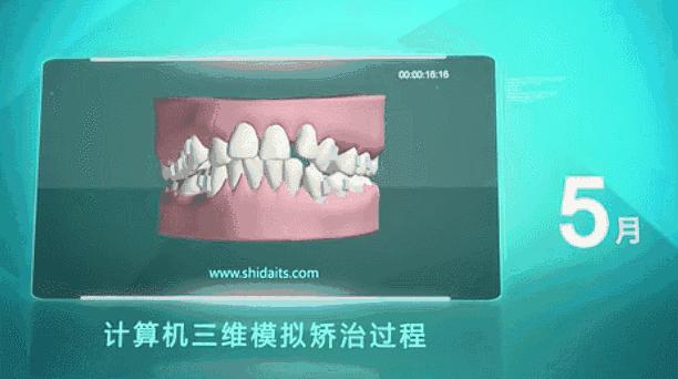 推广｜身份证42开头的注意！牙齿矫正、种植牙，这些全免费！