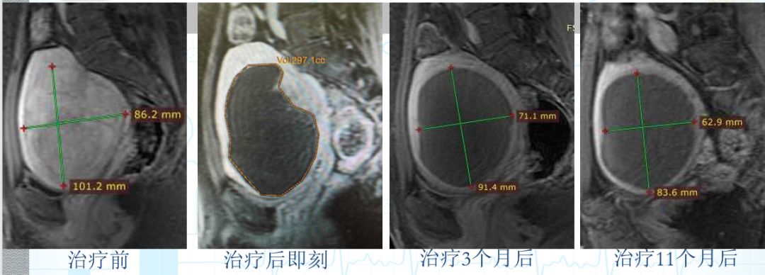 子宫腺肌症消融有效果吗,腺肌症和子宫肌瘤可以保守治疗吗