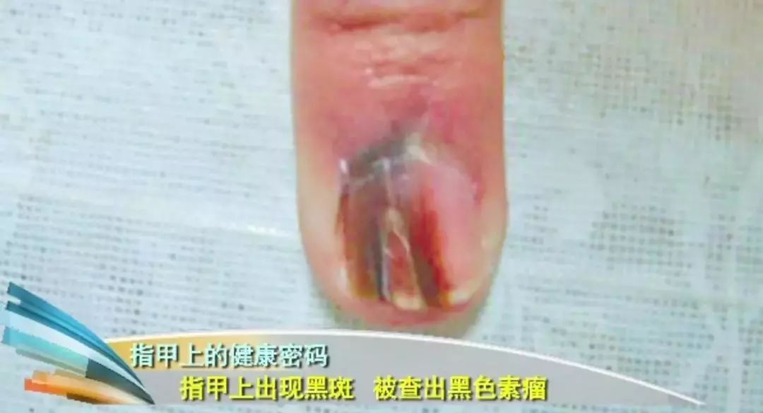 科普|指甲的状态反映了你身体的状态