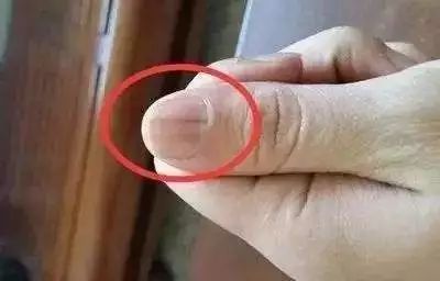 科普|指甲的状态反映了你身体的状态