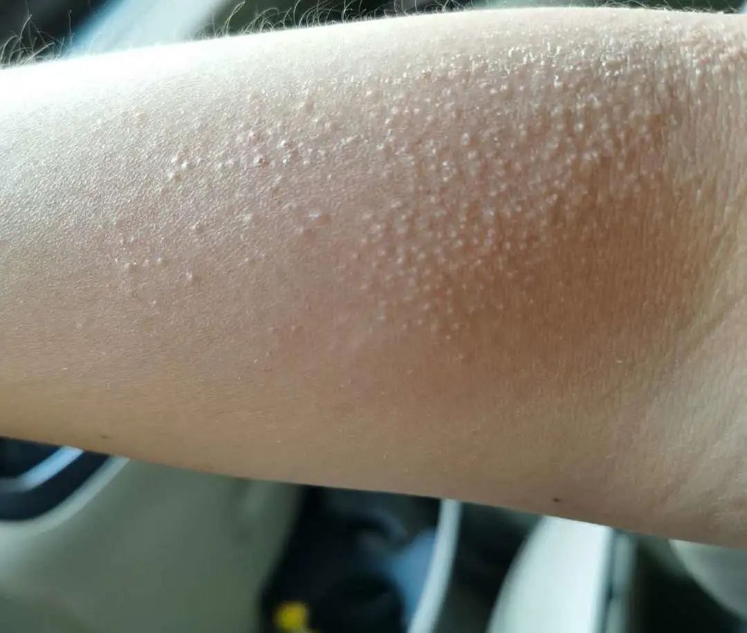 防晒这点事儿,防晒措施必须要做好