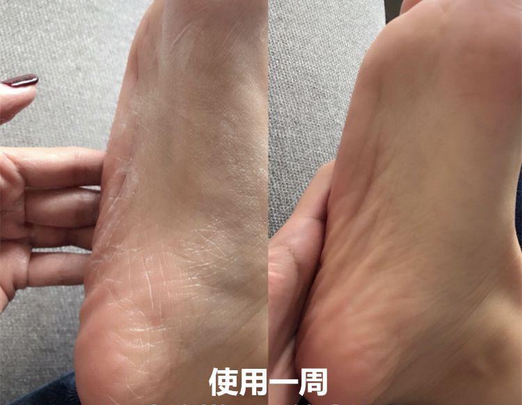 一招告别死皮老茧脚,去脚后跟老茧死皮的方法