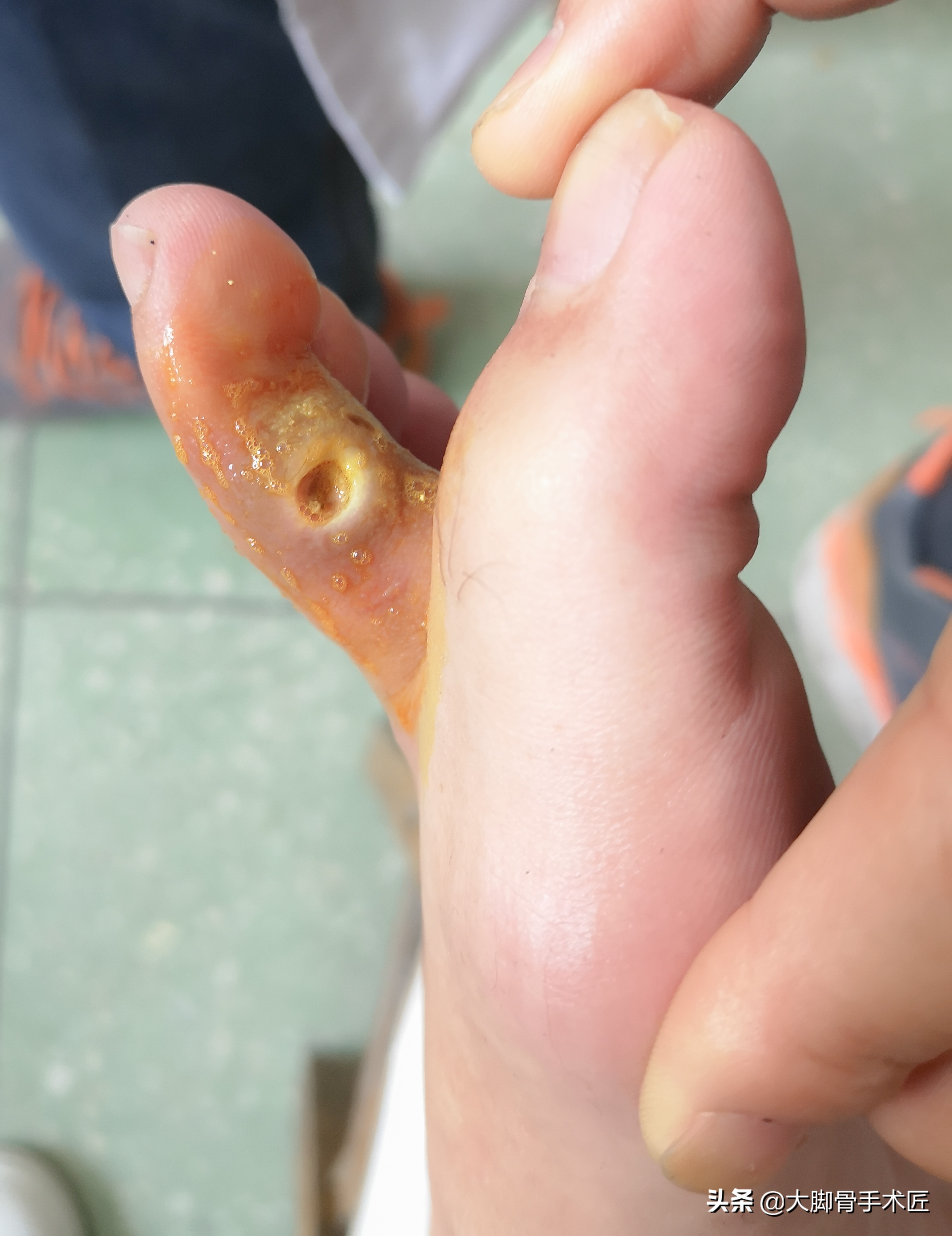 大脚骨导致哪里疼,大脚骨疼痛一招搞定