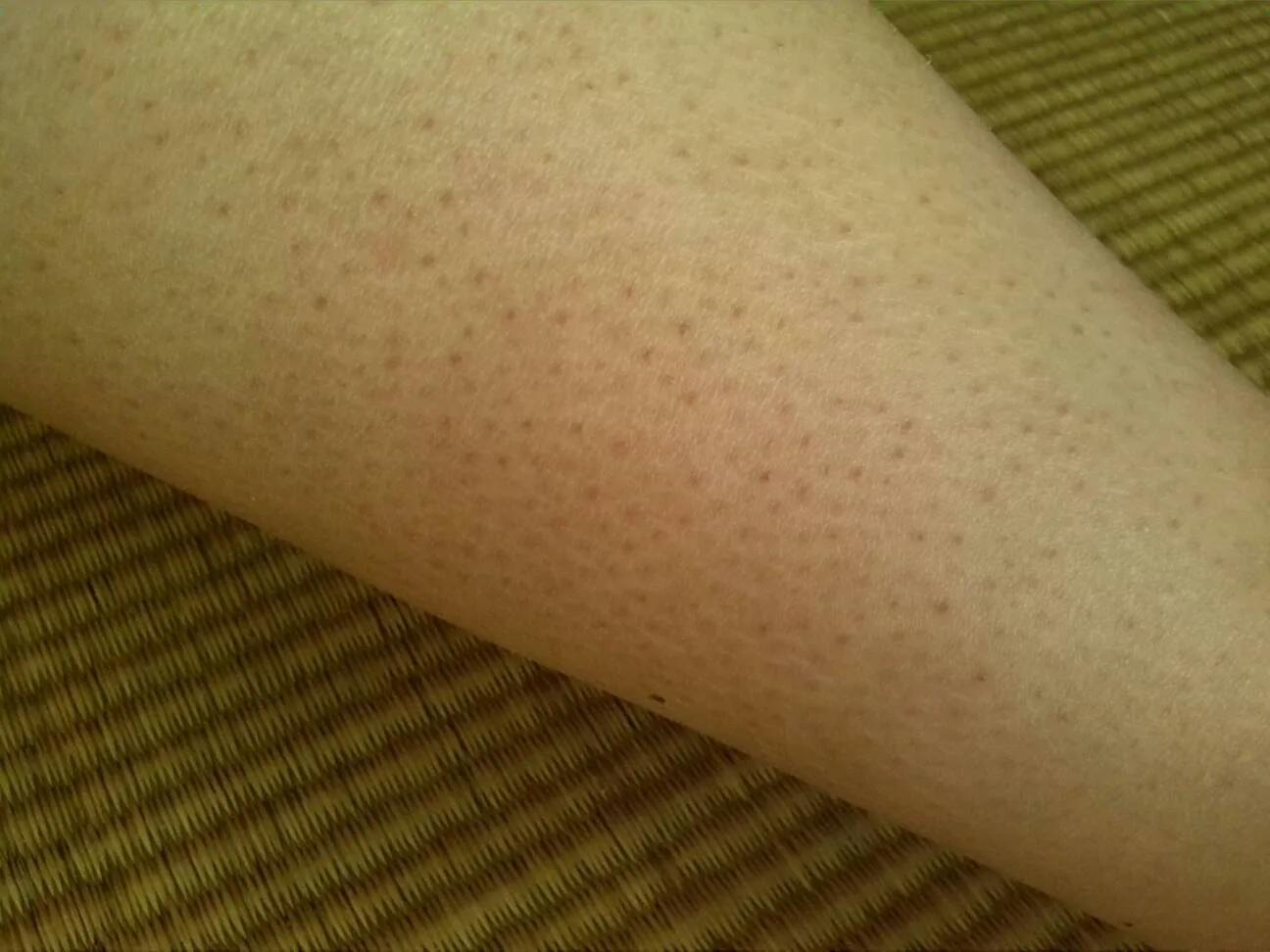 鸡皮肤痘印怎么治愈,鸡皮肤成因及如何去除