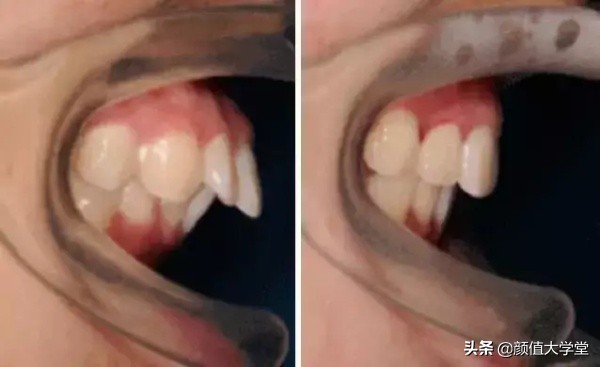 凸嘴有什么方法改善,形成嘴凸的原因