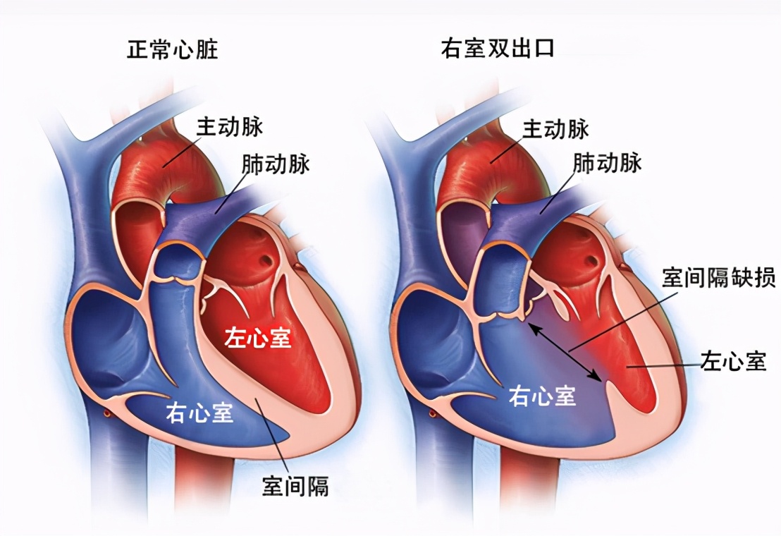 右心室双出口图解,右心室双出口术后影响生活吗