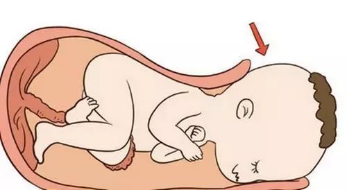 剖腹产的孩子容易感统失调吗,剖腹产的孩子需求做感统训练吗