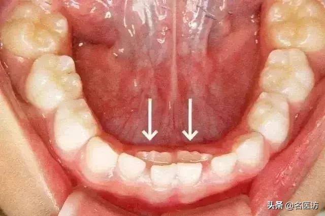 乳牙应该拔还是不拔,乳牙牙髓坏掉拔还是不拔