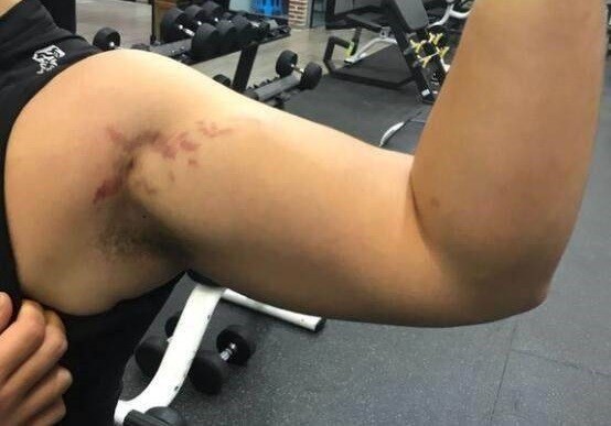 健身后皮肤有裂纹怎么回事,健身出现紫色条纹对身体有伤害吗
