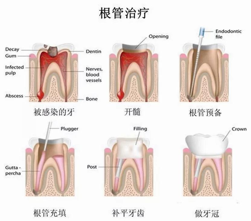 牙齿根管治疗不做牙套是什么样子,牙齿治疗中需求避开的误区