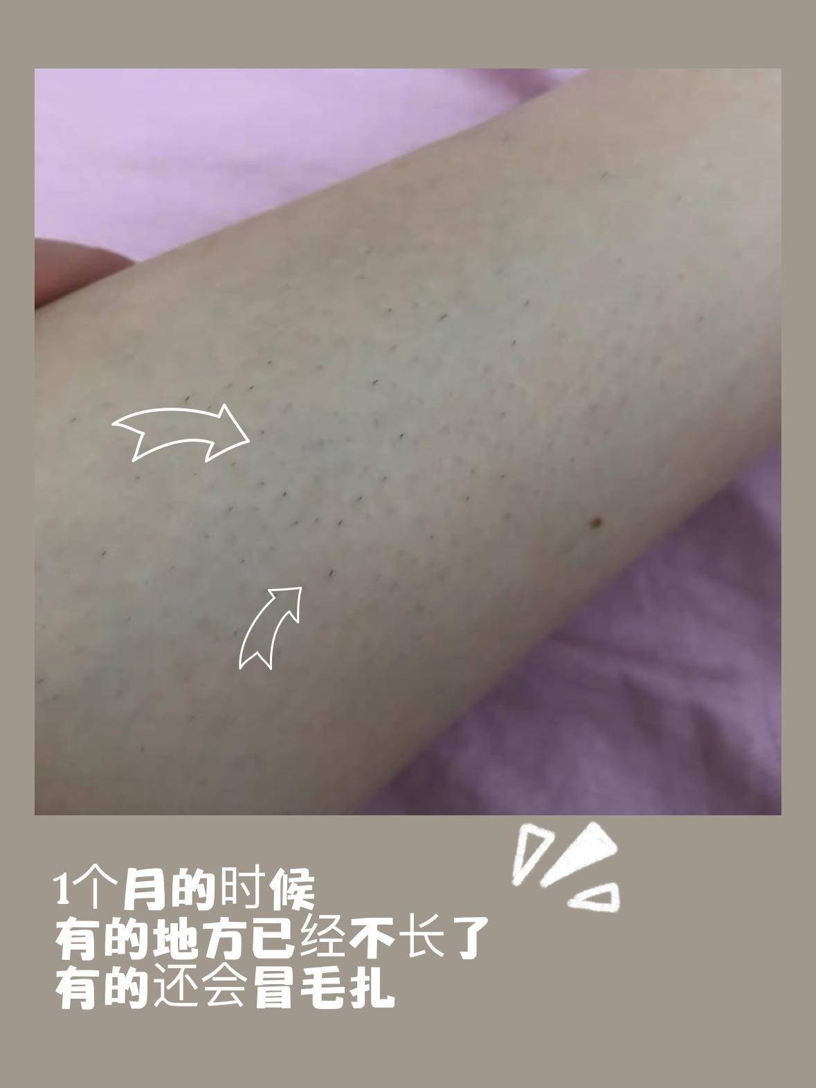脱毛仪买了一年了还有效果吗,脱毛仪到底哪个好用啊