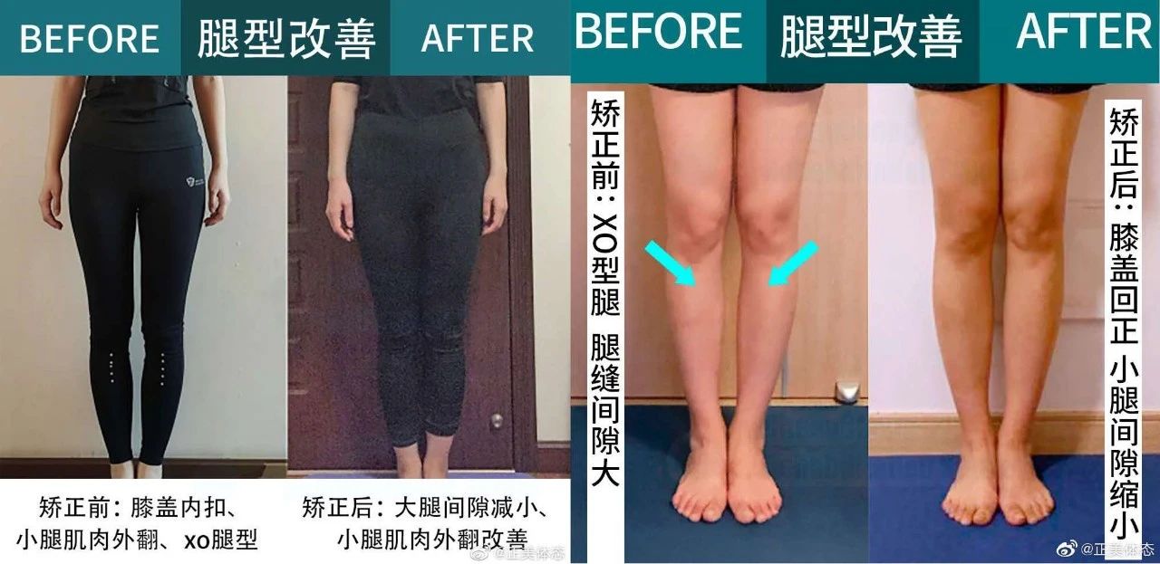怎么样让大腿更直,怎么让大腿型变直