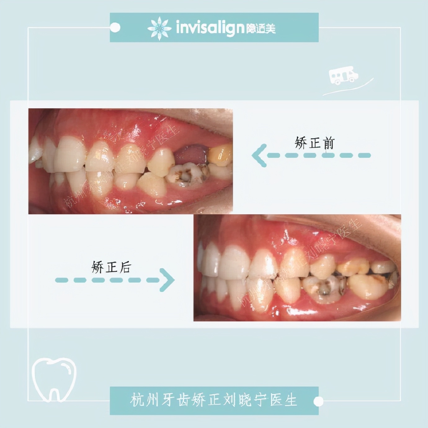 杭州牙齿矫正丨露龈笑怎么办？全面告别露龈笑的4大方法