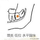 智齿分轻重嘛,智齿水平和非水平的区分