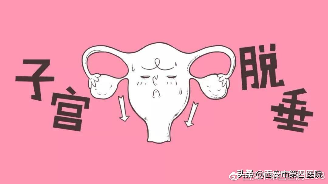 预防子宫脱垂患者的运动,产后如何预防子宫脱垂