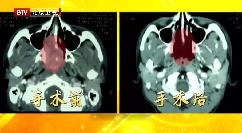 鼻出血可能是血液疾病不容忽视,鼻出血要警惕