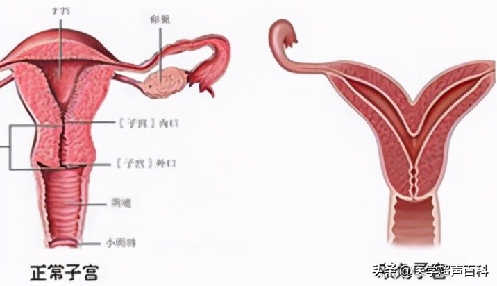子宫发育异常能怀孕吗,幼稚子宫和子宫发育不良的区分