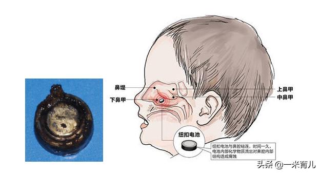 5岁鼻异物，18岁仍作妖！儿童发生鼻腔异物，先来做好这4步