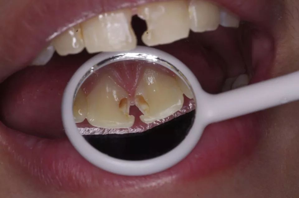蛀牙总是一颗接着一颗？看来你不只是需求补牙了