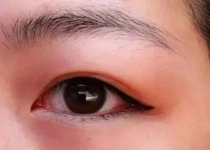 眼睛浮肿吃什么药可以缓解,眼睛浮肿怎么快速缓解