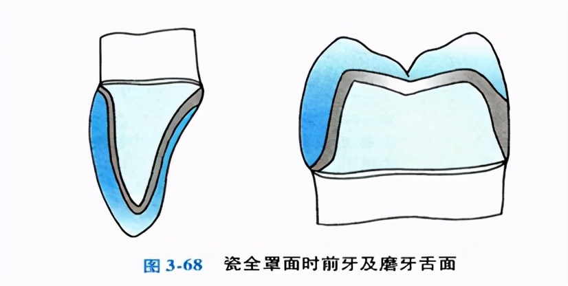 口腔金属冠与全瓷冠的区分,牙科医生讲义