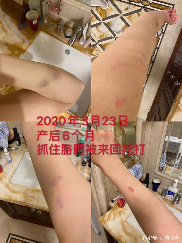美女主播爆运动员丈夫孕期家暴还被拔指甲，男方甩锅激素太无语