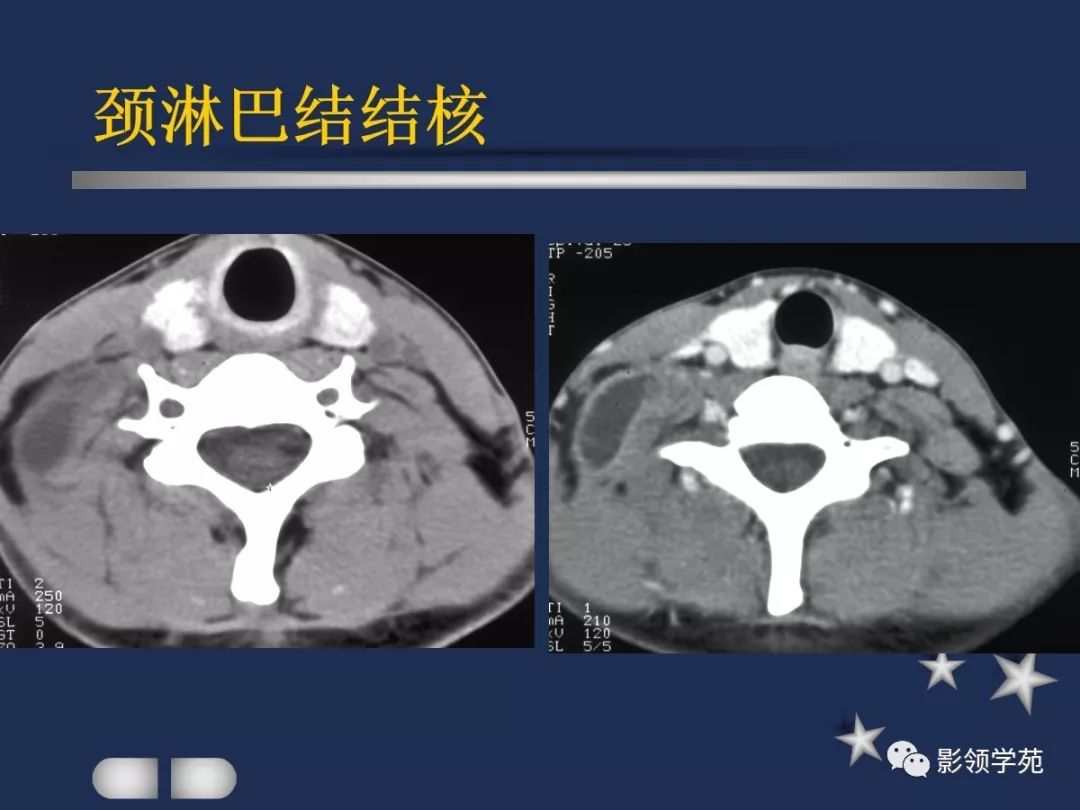 腮腺疾病影像学诊断,腮腺肿块影像诊断