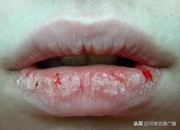 孕妇嘴皮干燥起皮喝水不缓解,孕妇嘴唇周边干燥起皮怎么办