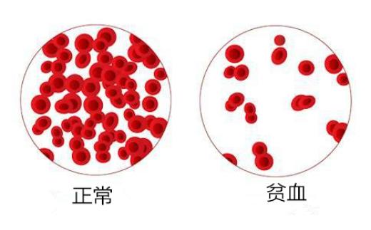 长子宫肌瘤跟贫血有关系吗,长子宫肌瘤气血不足长斑怎么调理