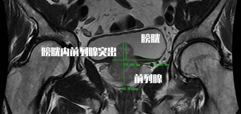 中医治疗前列腺增生什么药最有效,中医治疗前列腺增生多久能见效