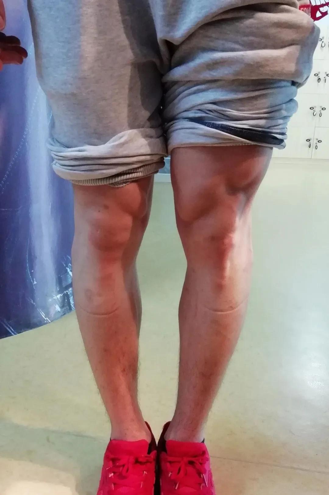 一岁半宝宝o型腿矫正视频,成年人o型腿矫正视频