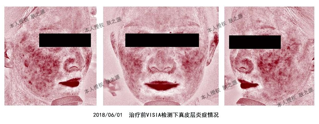 患者分享｜我的药物依赖合并玫瑰*疮痤**的治疗经历