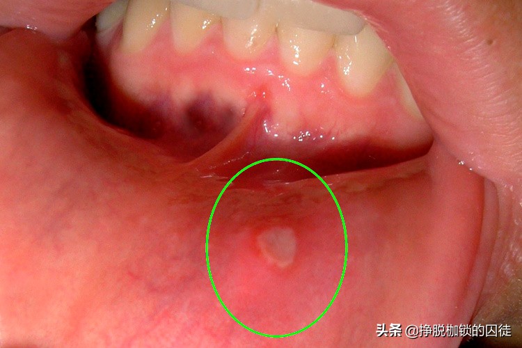 孩子口腔溃疡反复发作是什么原因,反反复复的口腔溃疡是什么引起的