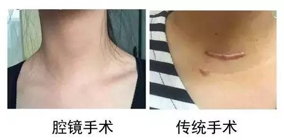彻底攻克疤痕的方法,想要去除疤痕怎么办