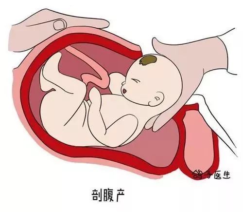 剖腹产的孩子容易感统失调吗,剖腹产的孩子需求做感统训练吗