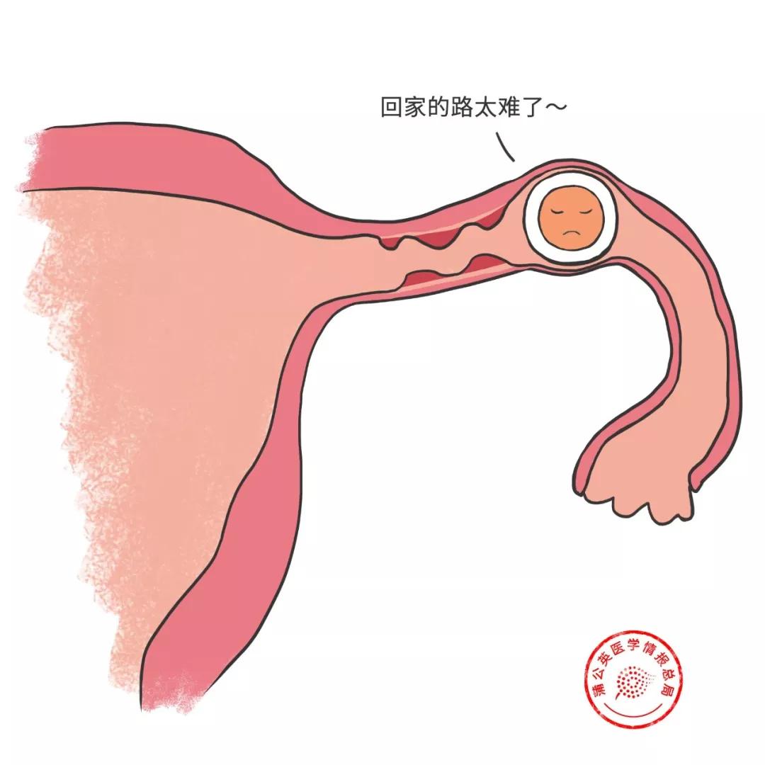 宫外孕有没有可能解决,宫外孕有没有三个月才发现的