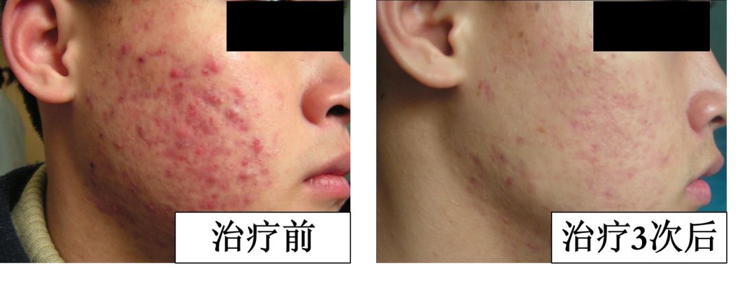 中医火针疗法教学视频,火针动手手法