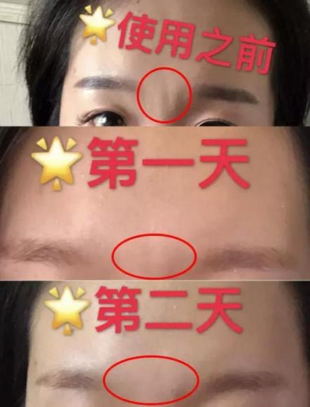 杨紫近照曝光无修图法令纹很深,杨紫面部填充法令纹